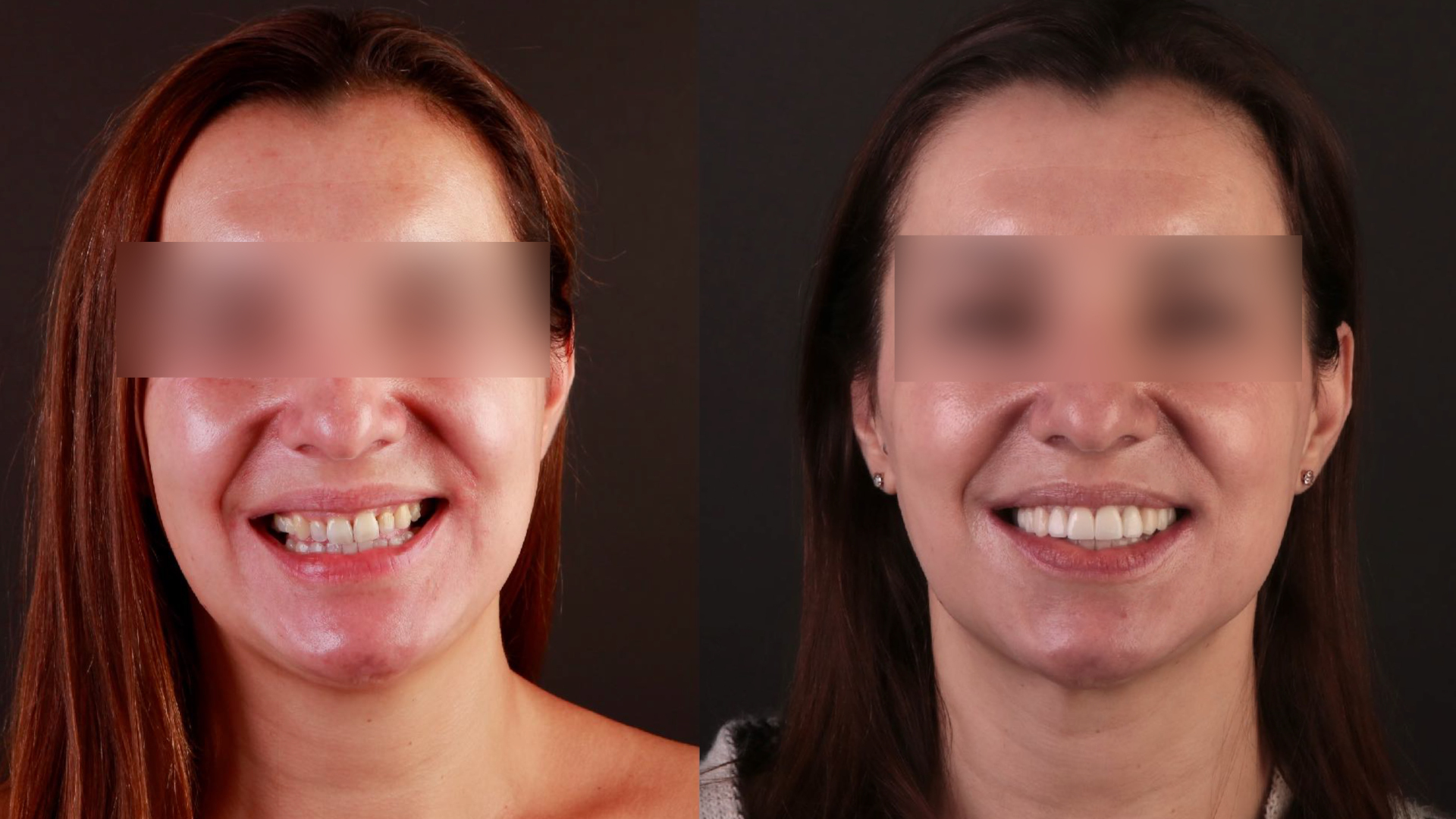 Figs. 7a & b: Comparison of (left) the initial situation with the final result with full-contour veneers, implants and a new vertical dimension after the aligner treatment.