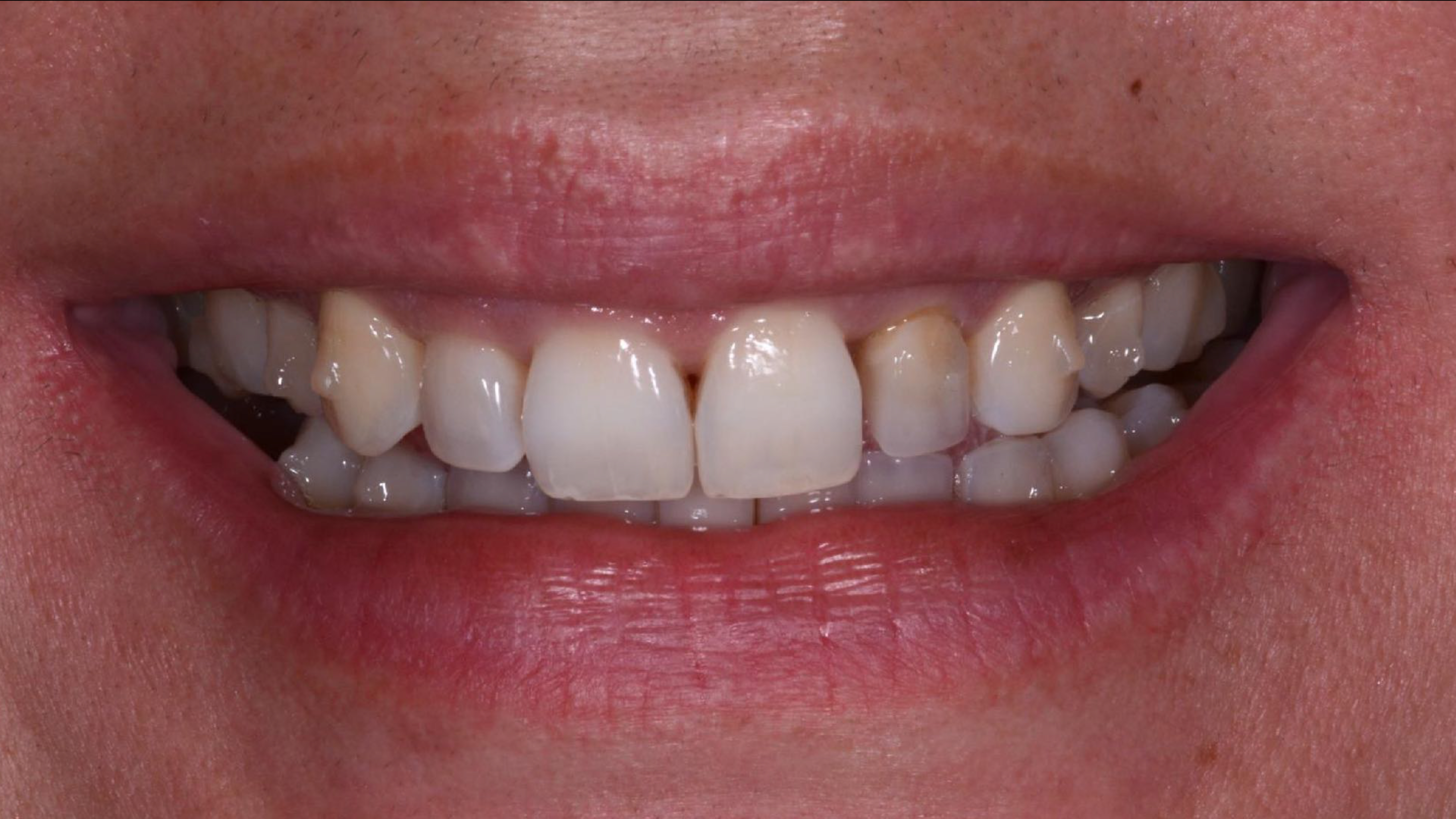 Fig. 1: Unhappy female patient after two years of aligner treatment. (All images: White Clinic)