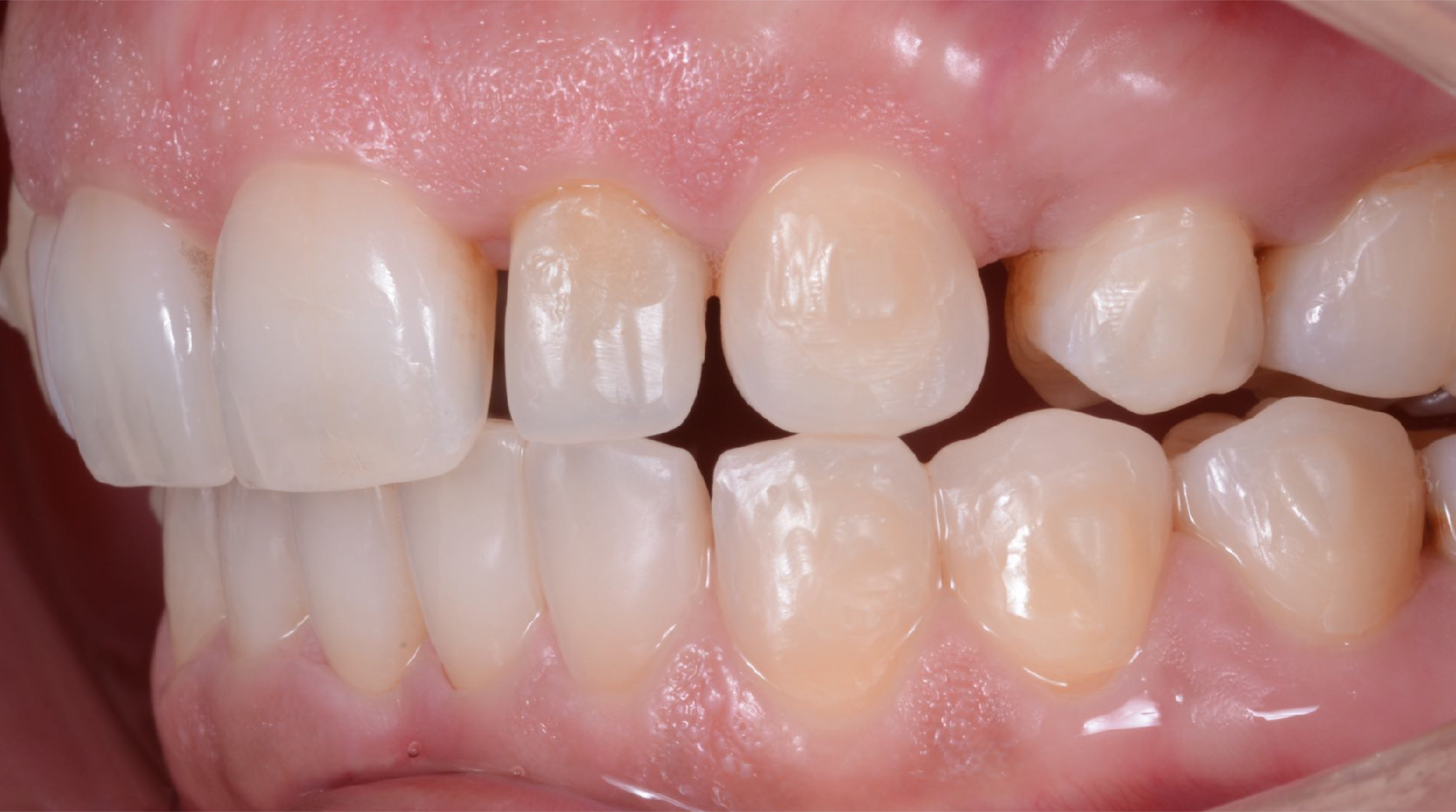 Fig. 3: Large gaps between the teeth caused by poor orthodontic planning.