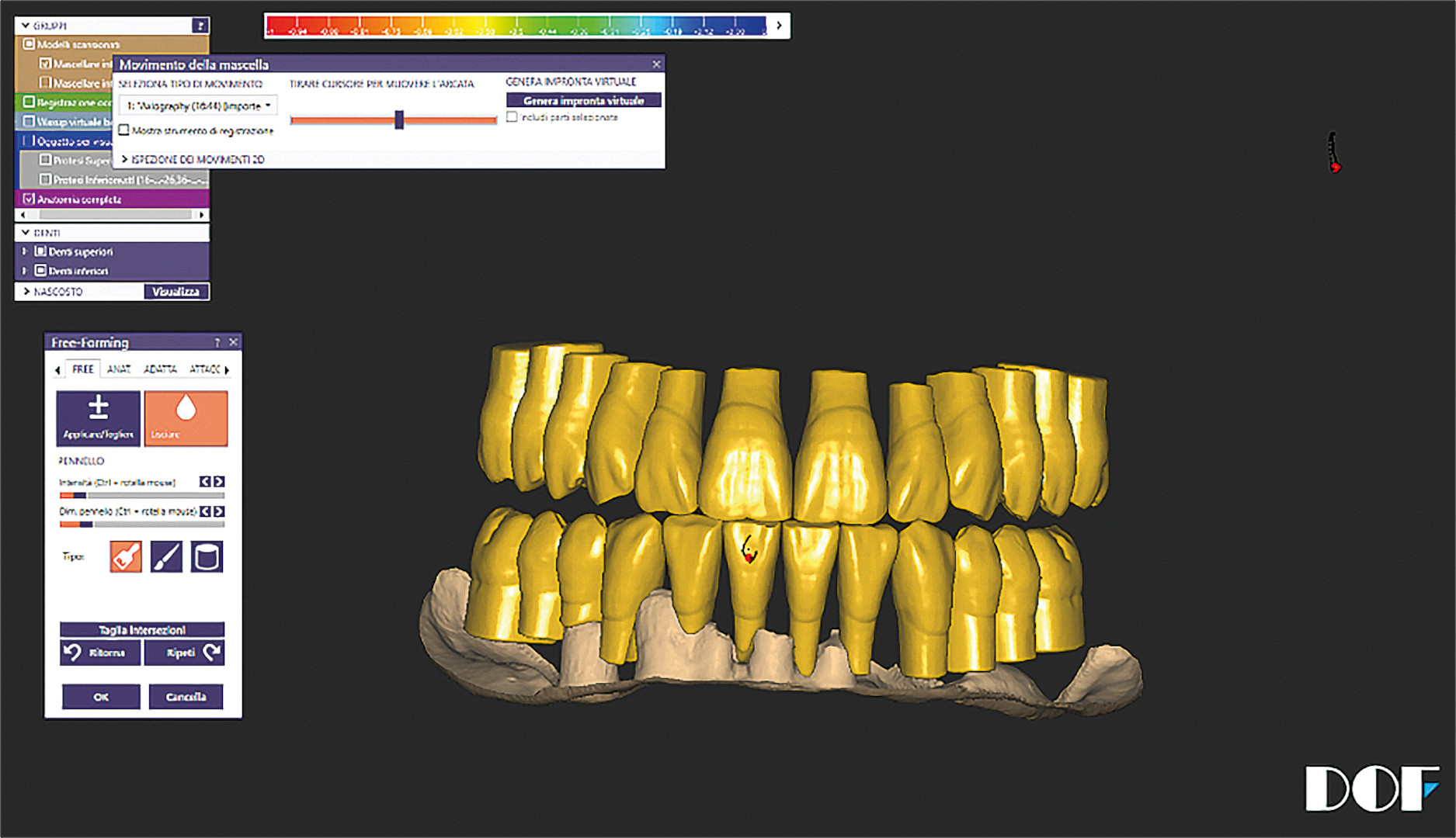 Dental News - Production of complete maxillary and mandibular dentures ...
