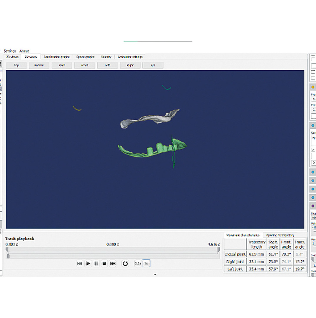 Dental News - Production of complete maxillary and mandibular dentures ...
