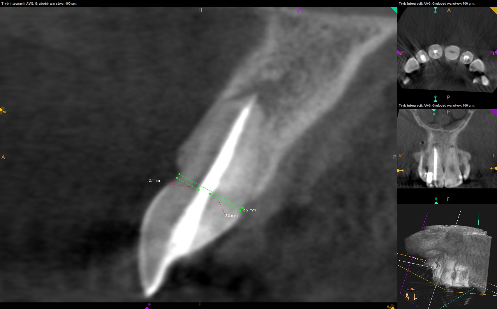 Root Thickness DT News - International - Digital technology in endodontics: Use of ...