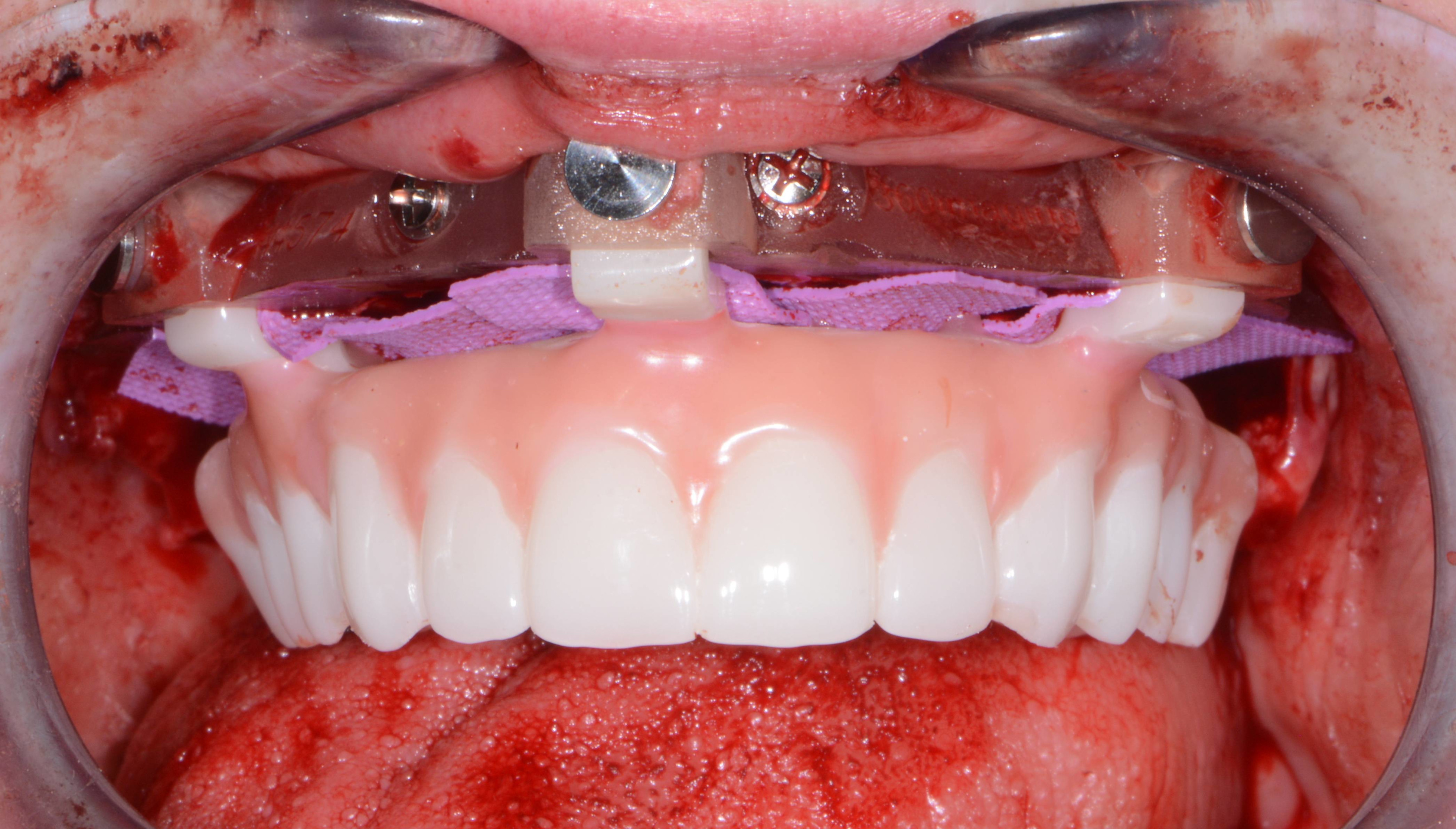 Fig. 11: Maxillary provisional restoration positioned on the guide.