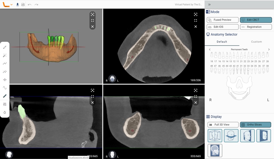 Fig. 1: Automatic segmentation from CBCT in Relu’s artificial intelligence-assisted, cloud-based software.