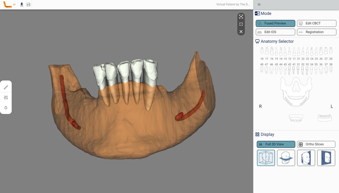 Fig. 2: Fusion and automatic alignment and superimposition of 3D files from the intra-oral scan over the CBCT data.