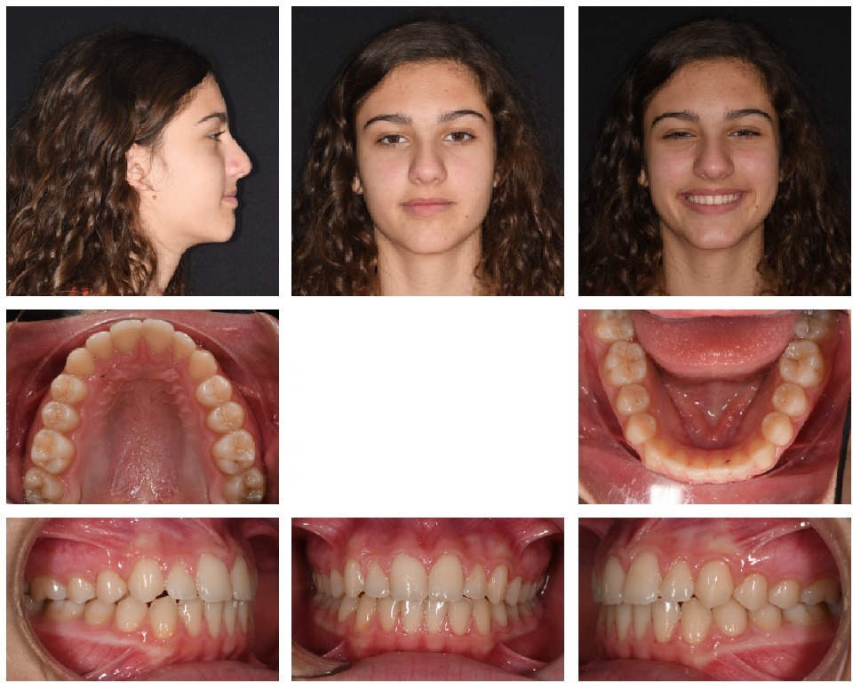 Figs. 13a–h: Mid-treatment facial and intra-oral photographs.