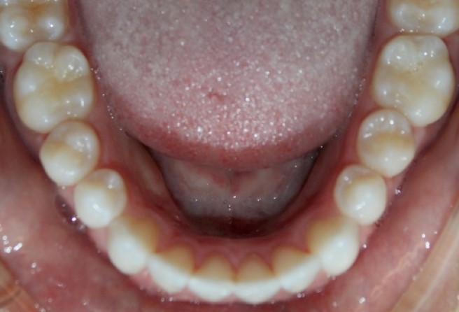 Fig. 1: Severely rotated mandibular left second premolar.