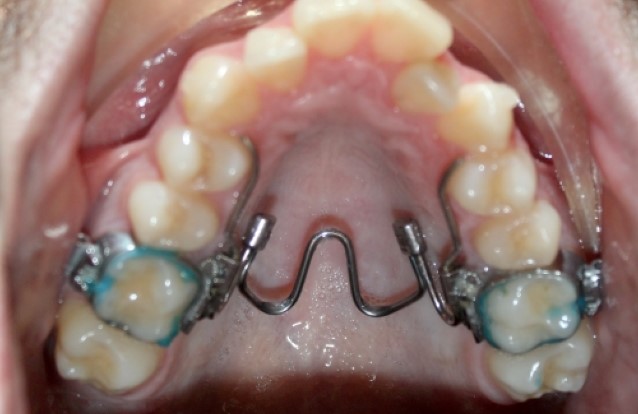 Fig. 14: Nitanium Palatal Expander2 (Henry Schein) with sectional canine–canine aligners.