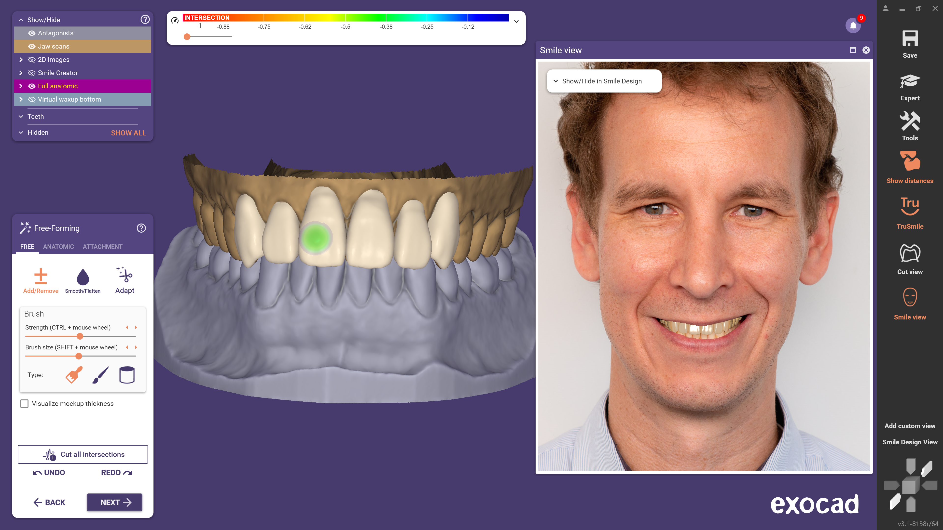 Smile Window shows a 2D preview of the finished smile design like it will appear in the patient’s mouth. (Image: exocad)
