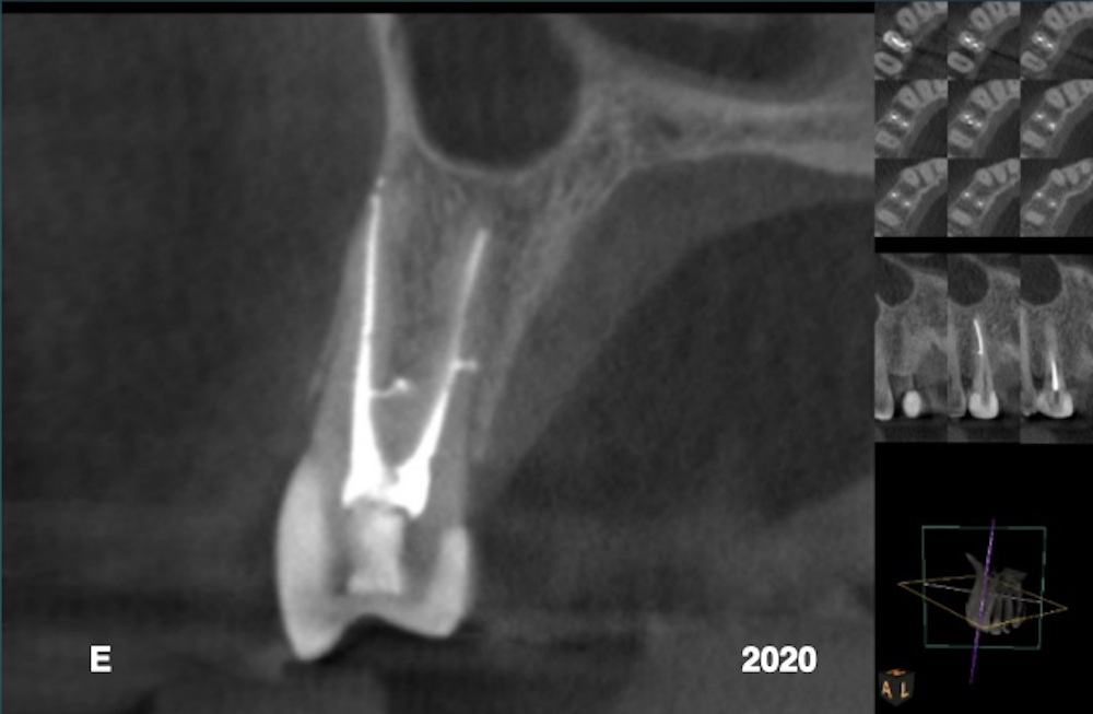 Fig. 21: A post-op periapical radiograph taken in 2020 showed osseous regeneration and reformation of the periodontal ligament in the infrabony defect along the distal aspect of the root.