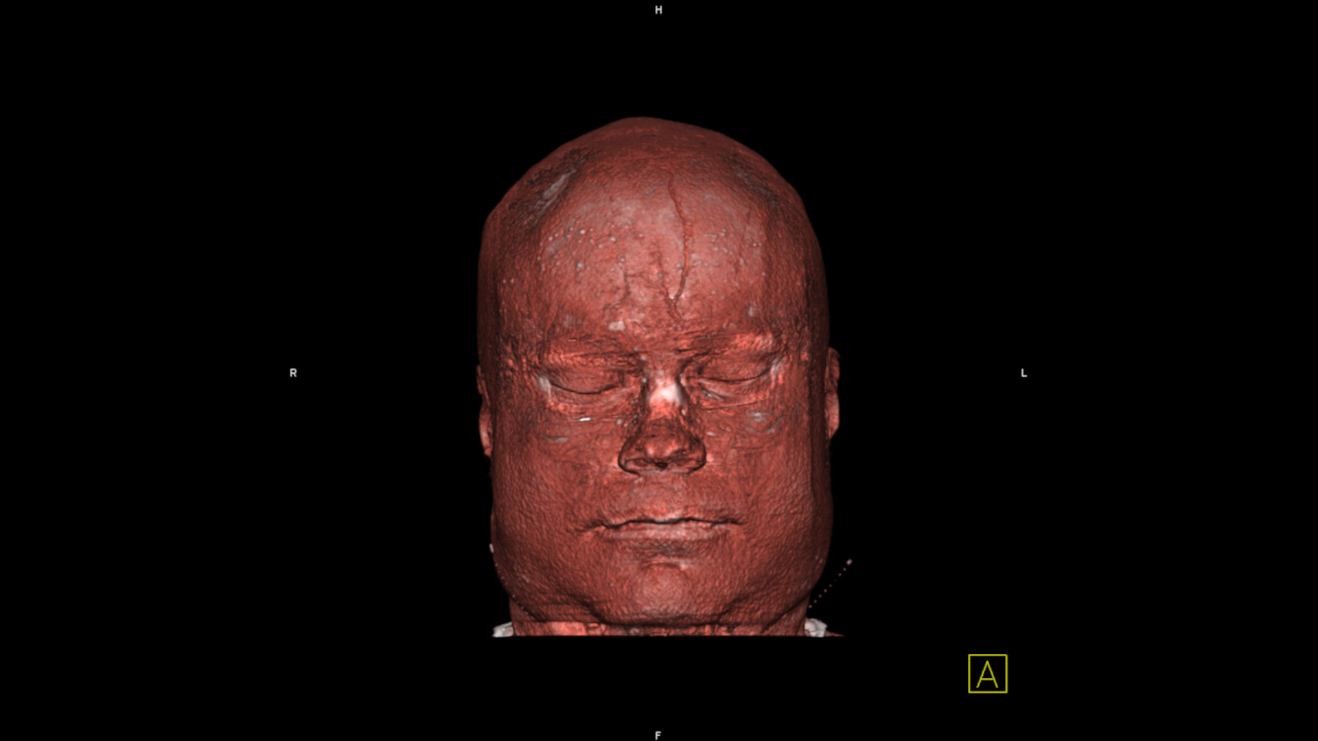 Examples of 3D scans provided by Dr Kustra of his own face. Taken with a Siemens Somatom Sensation Cardiac 64 spiral CT scanner, such images are useful for virtual endoscopy planning. 