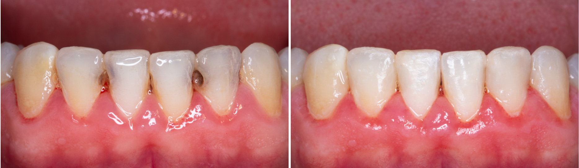 DT News International Transforming dentistry Direct restoration