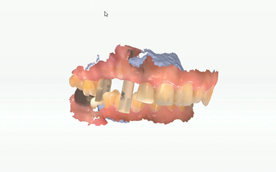 Fig. 4: Scan with the teeth in occlusion.