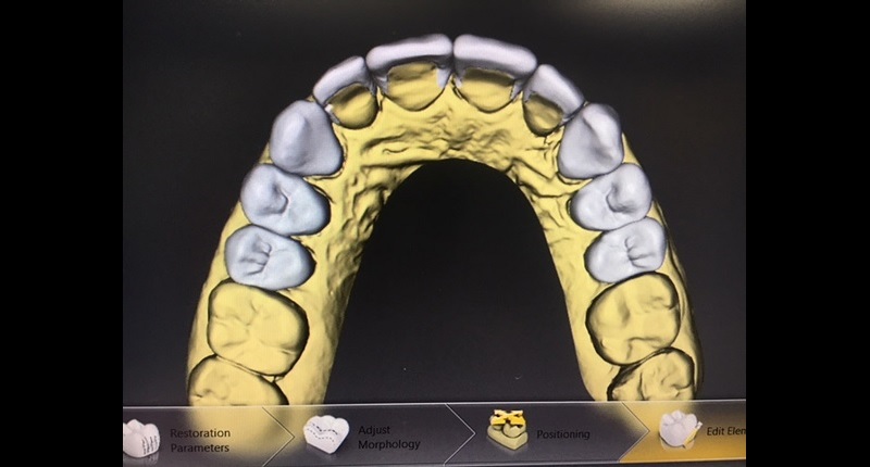 Fig. 5: Occlusal view of the digital proposal, showing the ach form and occlusal design for the case.