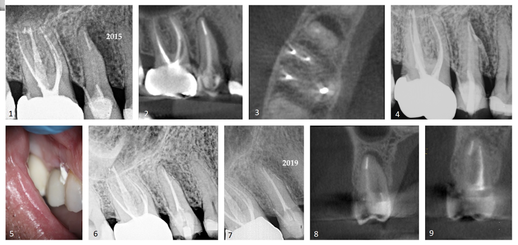 Case 1—Fig. 1: An area of periradicular rarefaction was evident along the mesio-proximal aspect of tooth #15. Previous root canal therapy and a pin-retained post and core supporting a zirconia crown were noted. Fig. 2: The sagittal slice of the CBCT volume showed the lateral lesion extending to the alveolar crest. Fig. 3: The axial slice of the CBCT volume showed the extent of the rarefaction adjacent to the mesial aspect of the root and the presence of an untreated palatal canal. Fig. 4: Selective treatment of the palatal canal was performed. Calcium hydroxide was inserted in the canal space. Fig. 5: The extrusion of the interim calcium hydroxide medicament through the sulcular area of tooth #15 was evident. Fig. 6: A lateral branch of the root canal space containing the obturation material exited into the interface of the middle and apical thirds of the root. Fig. 7: A periapical radiograph taken four years after treatment showed osseous regeneration and the reformation of the periodontal ligament. Fig. 8: The coronal slice of the CBCT volume showed the pre-op periradicular radiolucency. Fig. 9: The coronal slice of the CBCT volume taken four years after treatment showed the resolution of the periradicular radiolucency.
