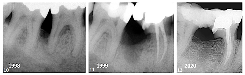 Case 2—Fig. 10: Loss of bone between tooth #47 and tooth #46 and loss of the periodontal ligament around the apical region of the mesial and distal roots were evident. Fig. 11: After resection of the distal root, the degree of bone loss appeared to have increased. Fig. 12: A 22-year follow-up showed regeneration of the lost interproximal bone and cortication of the alveolar crest.