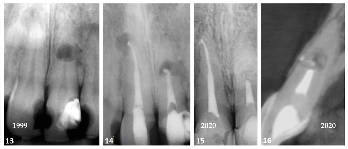 Case 3—Fig. 13: The intra-oral periapical radiograph revealed a periradicular radiolucency at the root apex of tooth #11. A large area of internal resorption was evident mid-root of tooth #21. The resorption had perforated the lateral aspect of the root, causing disruption of the interproximal bone. Fig. 14: A post-op radiograph showed the endodontic treatment of tooth #11. Tooth #21 was sealed with white mineral trioxide aggregate to the incisal level of the resorptive defect, as it demonstrated minimal root discoloration. Fig. 15: The periradicular radiolucency associated with tooth #11 had resolved. The resorptive defect was reduced, and radiolucent deposits were evident within the resorptive crypt. Fig. 16: The sagittal slice of the CBCT volume showed an intact cortical plate. The presence of calcified deposits was evident in the residual resorptive defect, which had significantly reduced.
