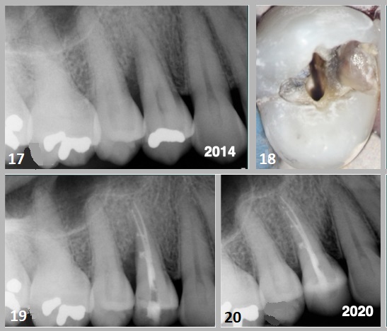 Case 4—Fig. 17: An 8mm infrabony defect was evident along the distal proximal aspect of the root of tooth #15. Fig. 18: Debris present in the distal marginal ridge of the tooth #14 demonstrated a fracture line; however, there was no indication of cuspal separation. Removal of the amalgam revealed extension of the fracture into the cuspal stress plane of the buccal and axial line angle. Fig. 19: The root canal space was obturated using a warm vertical condensation technique. Lateral branches of the root canal system were noted. Fig. 20: A post-op periapical radiograph taken in 2020 showed osseous regeneration and reformation of the periodontal ligament in the infrabony defect along the distal aspect of the root.