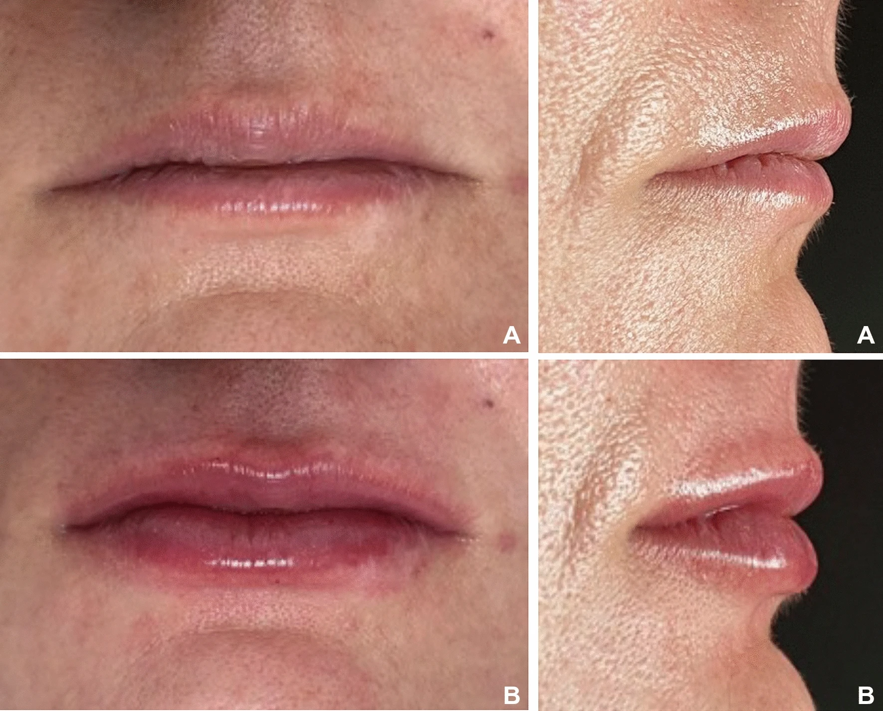 Patient from the group with thinner lips (a) before lip filling and (b) ten days after lip filling. (Image: De Queiroz Hernandez et al., licensed under CC BY 4.0)