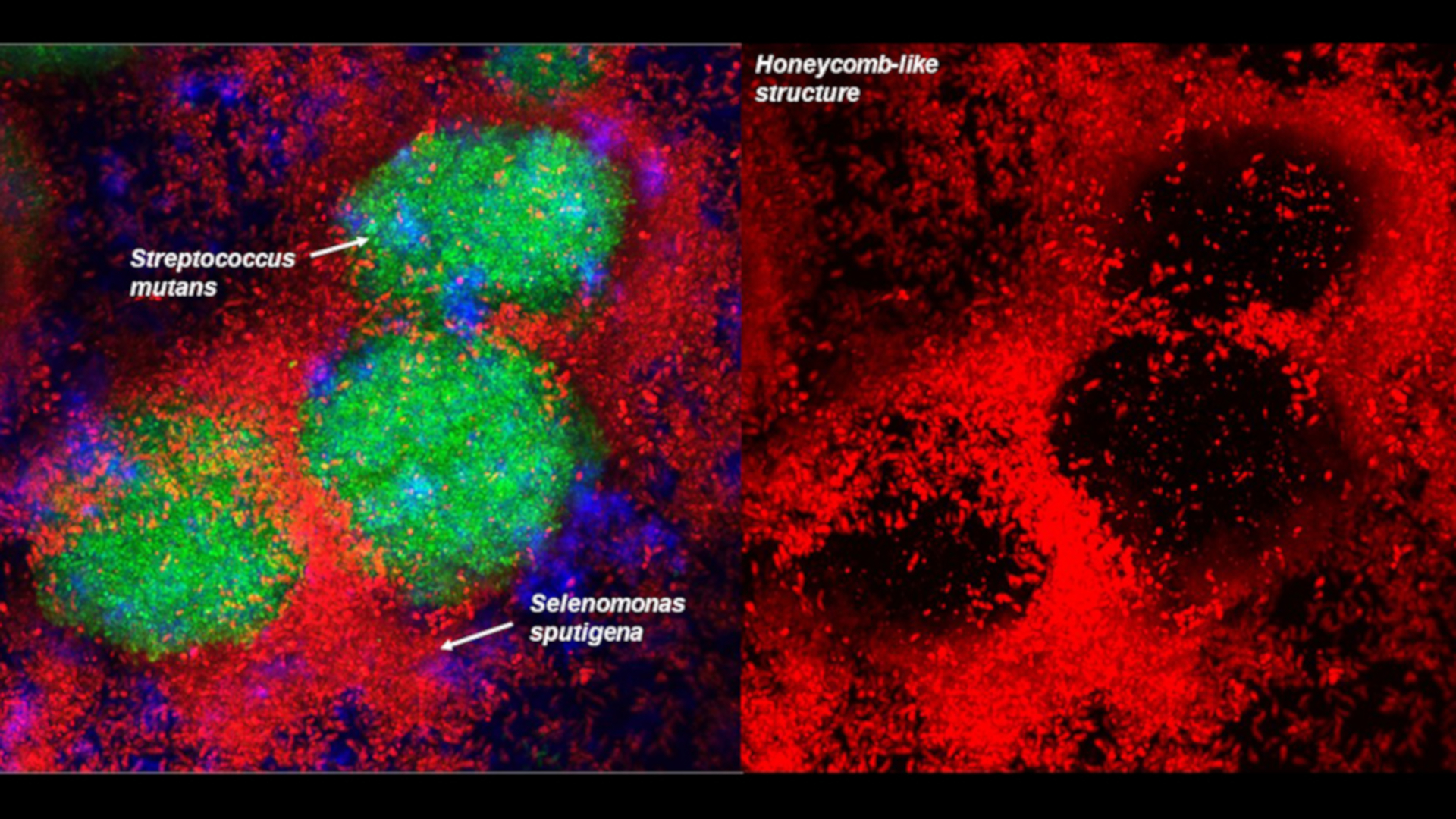 study-identifies-new-bacterial-species-involved-in-dental-caries