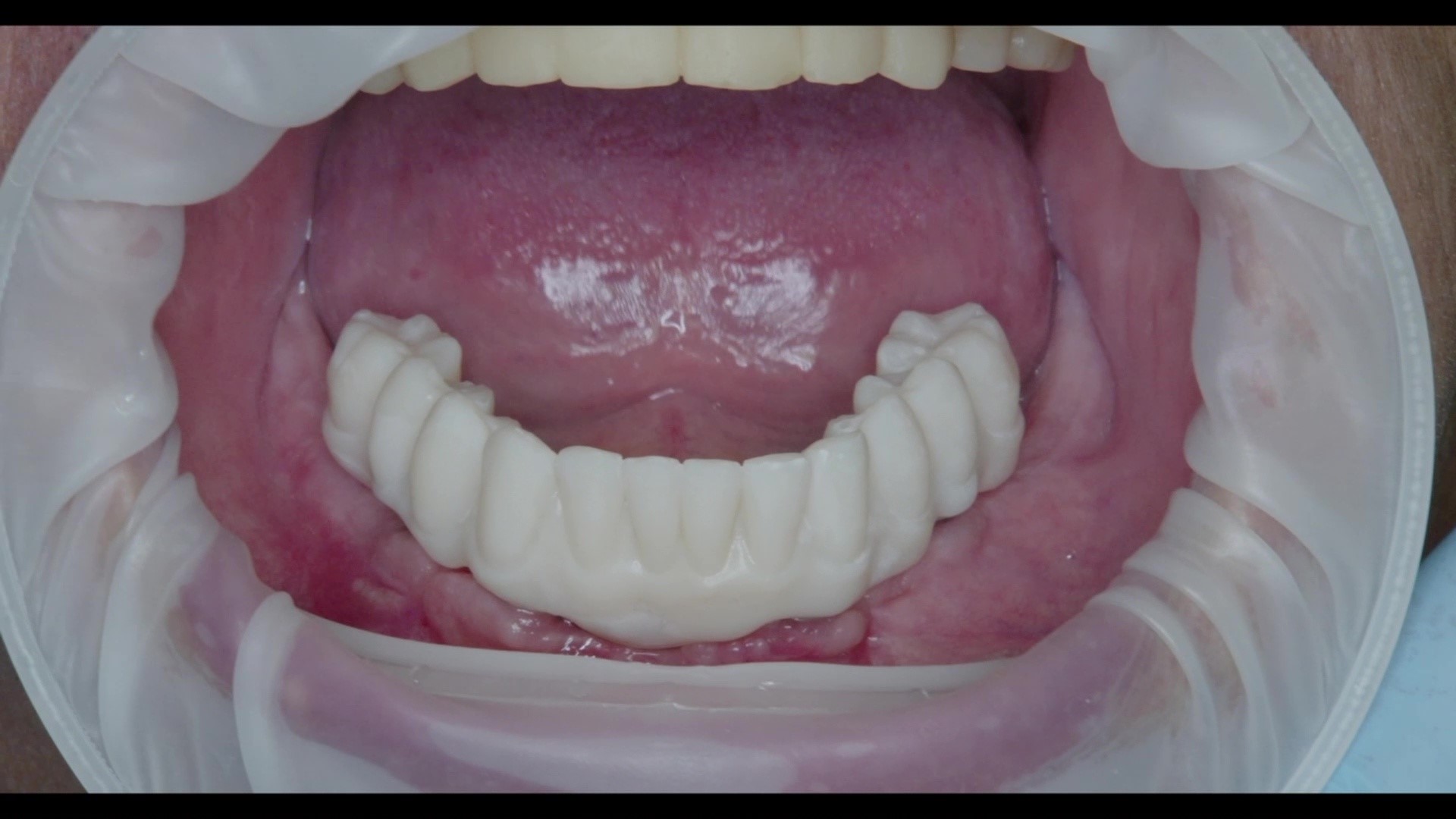 Fig. 14: Try-in of the lower jaw prosthesis.