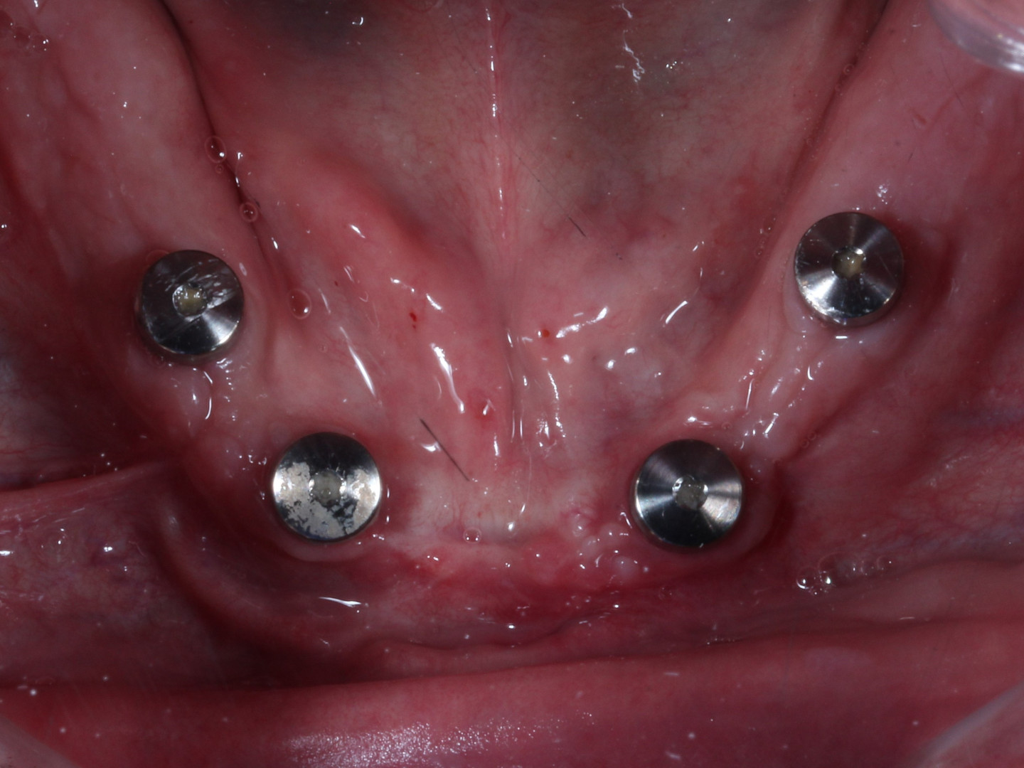 Fig. 2: Dental implants placed in the lower jaw.