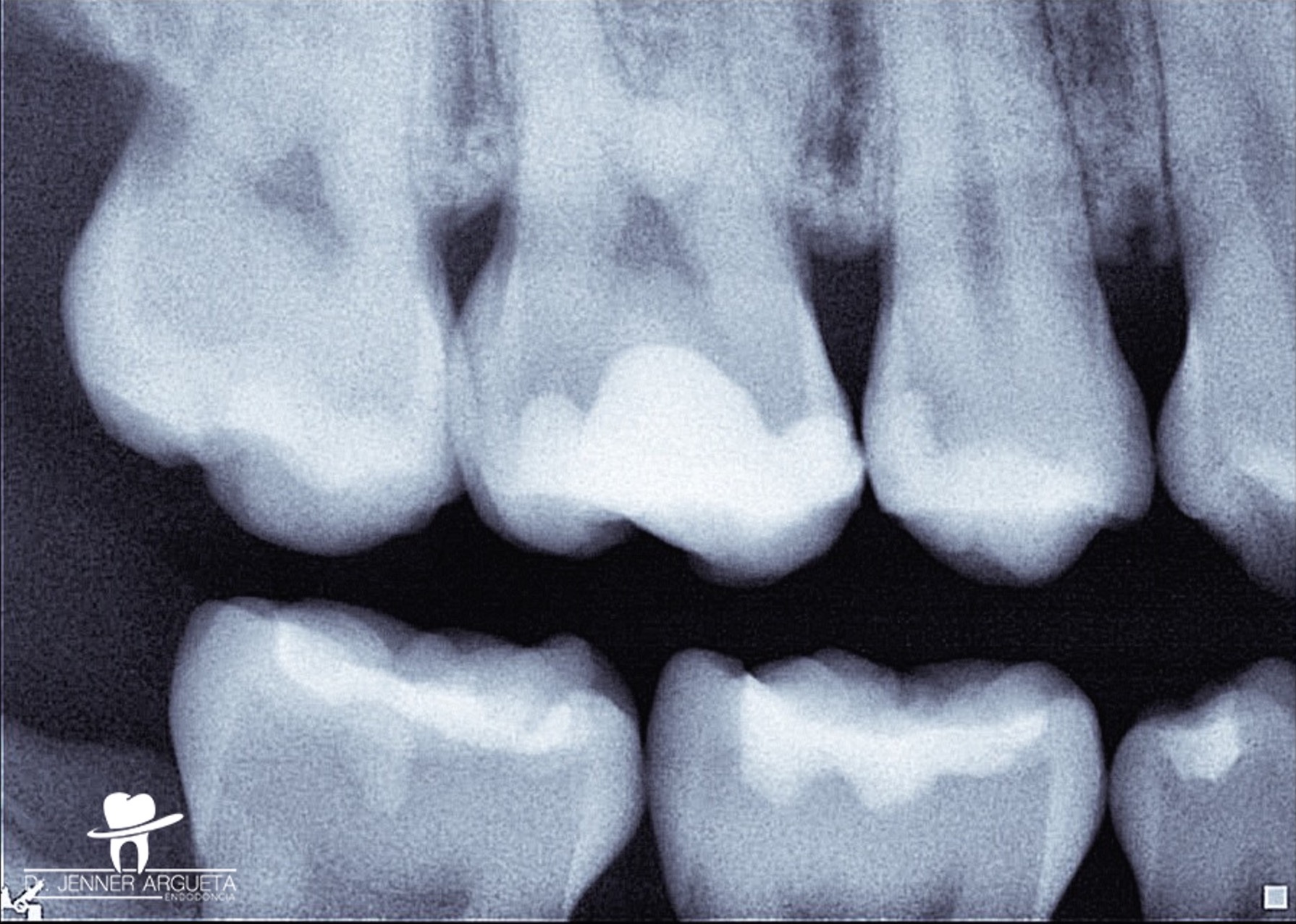 The cavity of the tooth #16 after the removal of the temporary and