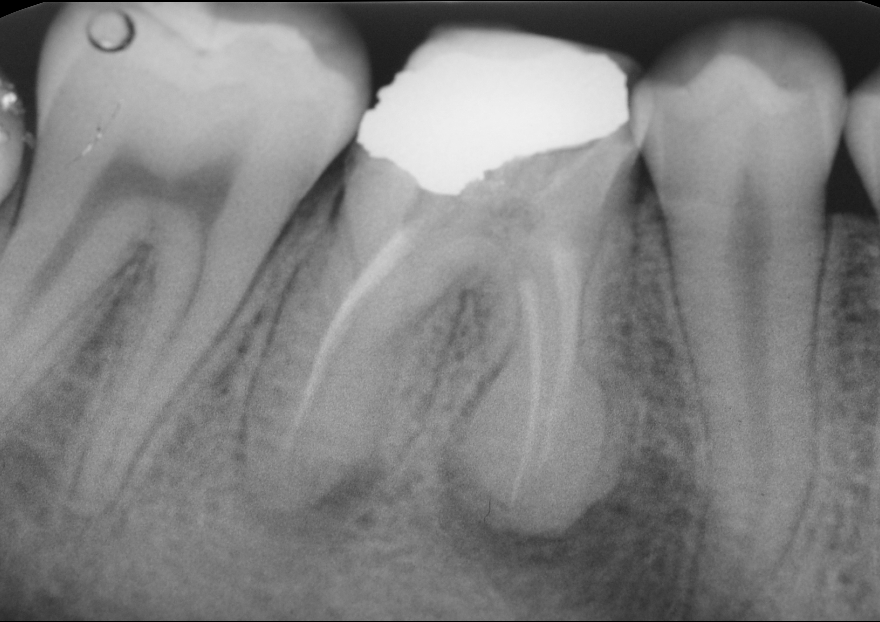 Fig. 1: Radiograph of the pre-op situation showing insufcient endodontic treatment of tooth #46. Additionally, an amalgam coronal restoration with microleakage was detected. There were also apical lesions evident around both roots. Both neighbouring teeth had migrated towards tooth #46 and closed the interproximal spaces.