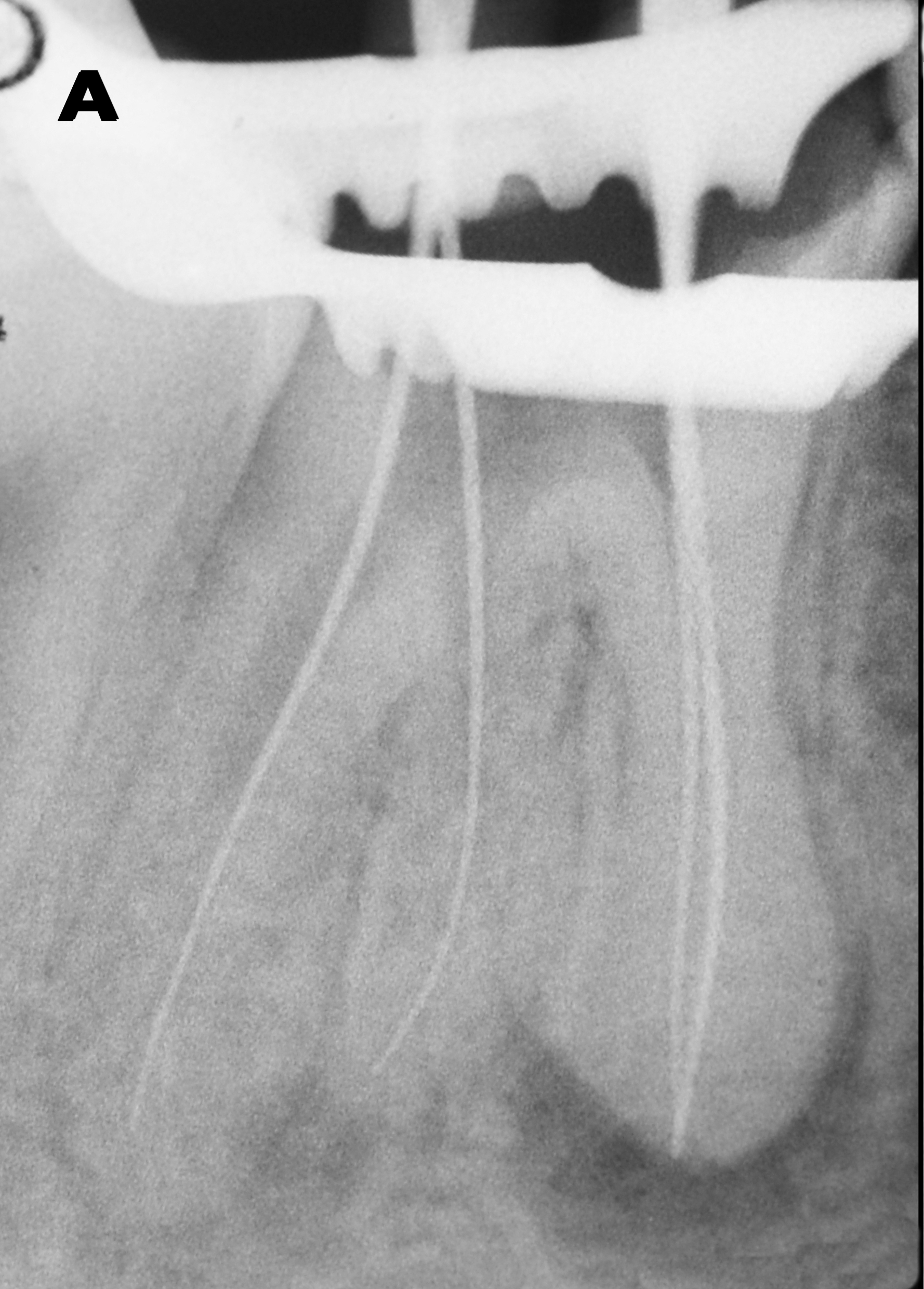 Fig. 2a: Radiographs of the endodontic treatment. Working length control (a).