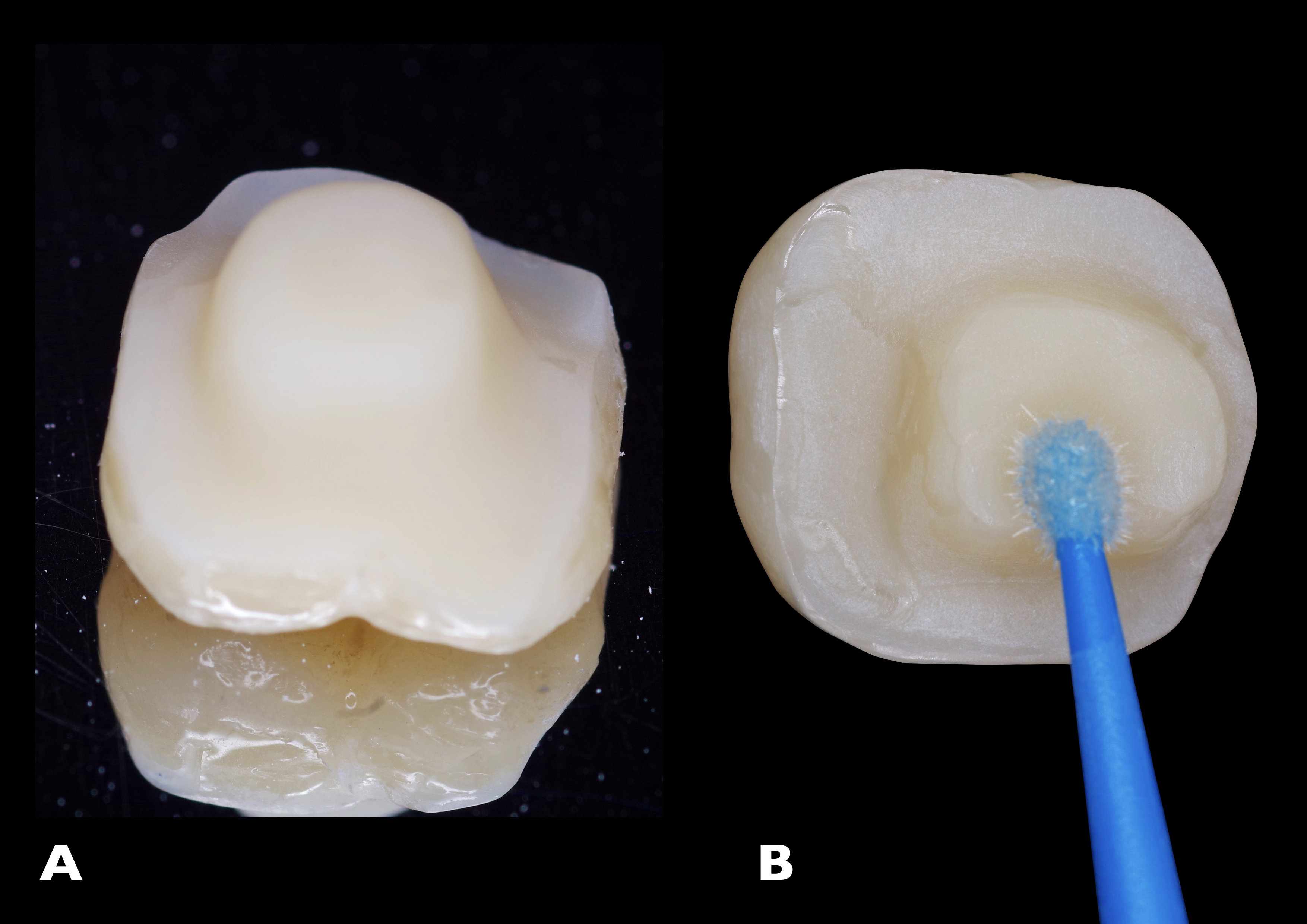 Figs. 18a & b: Inner surface of the endocrown after sandblasting with aluminium oxide particles, followed by cleaning of the surface with distilled water and detergent (a). Application of Ceramic Bond (b).