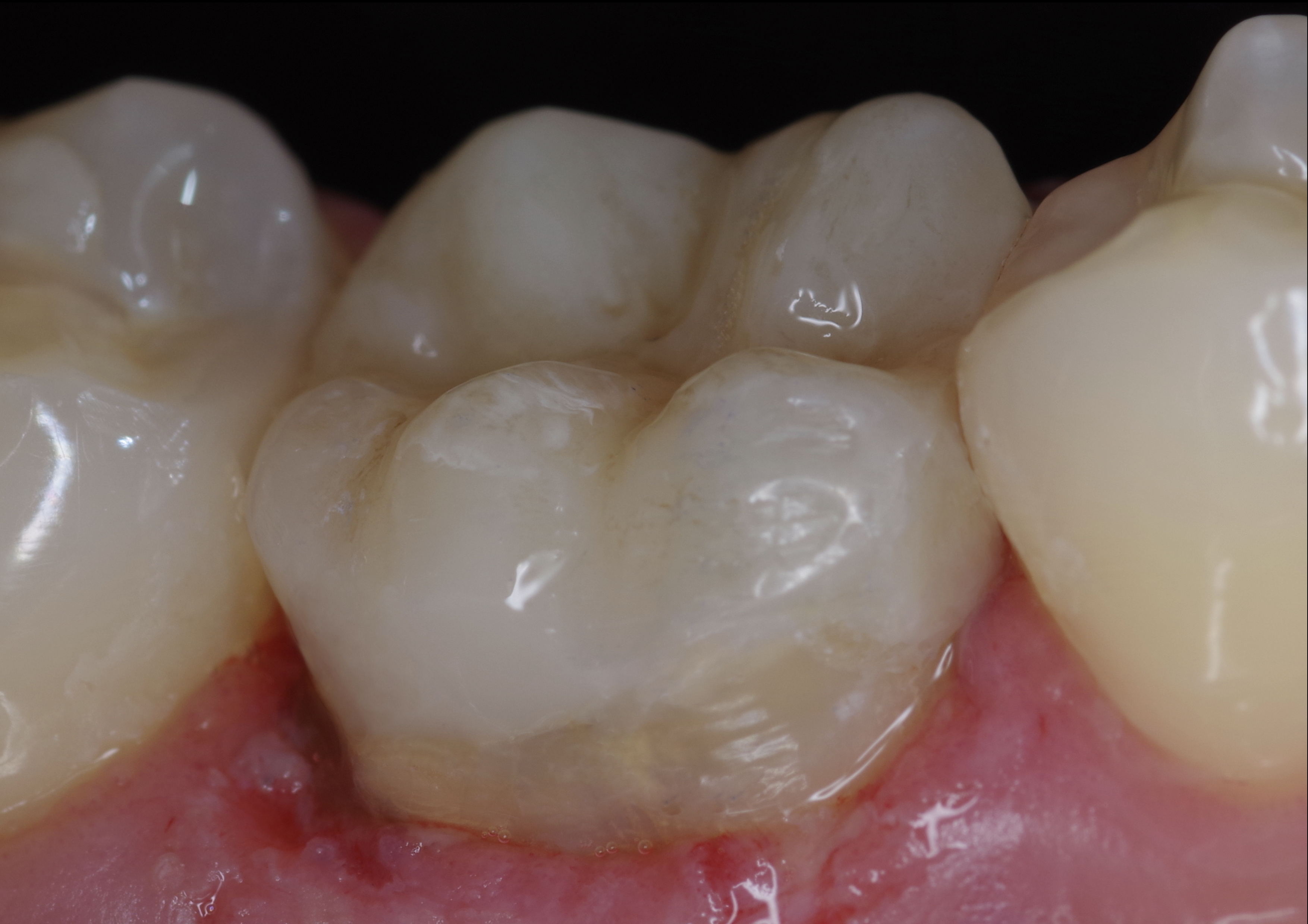 Fig. 21: After placement of the restoration and removal of excess adhesive cement and polishing of the margins and the surface.