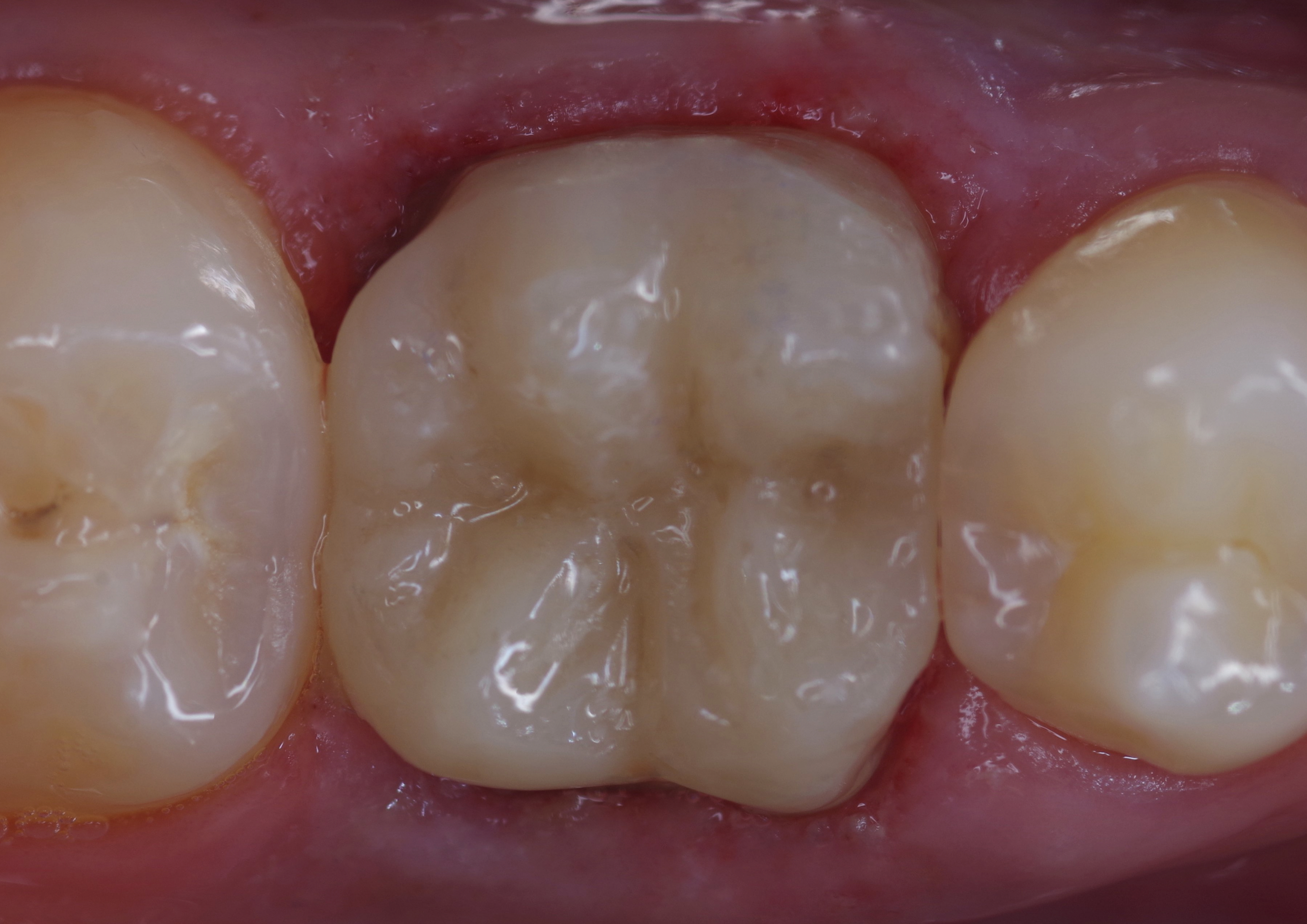 Fig. 22: After polishing of the occlusal surface. The gingivae had been injured and needed to heal.
