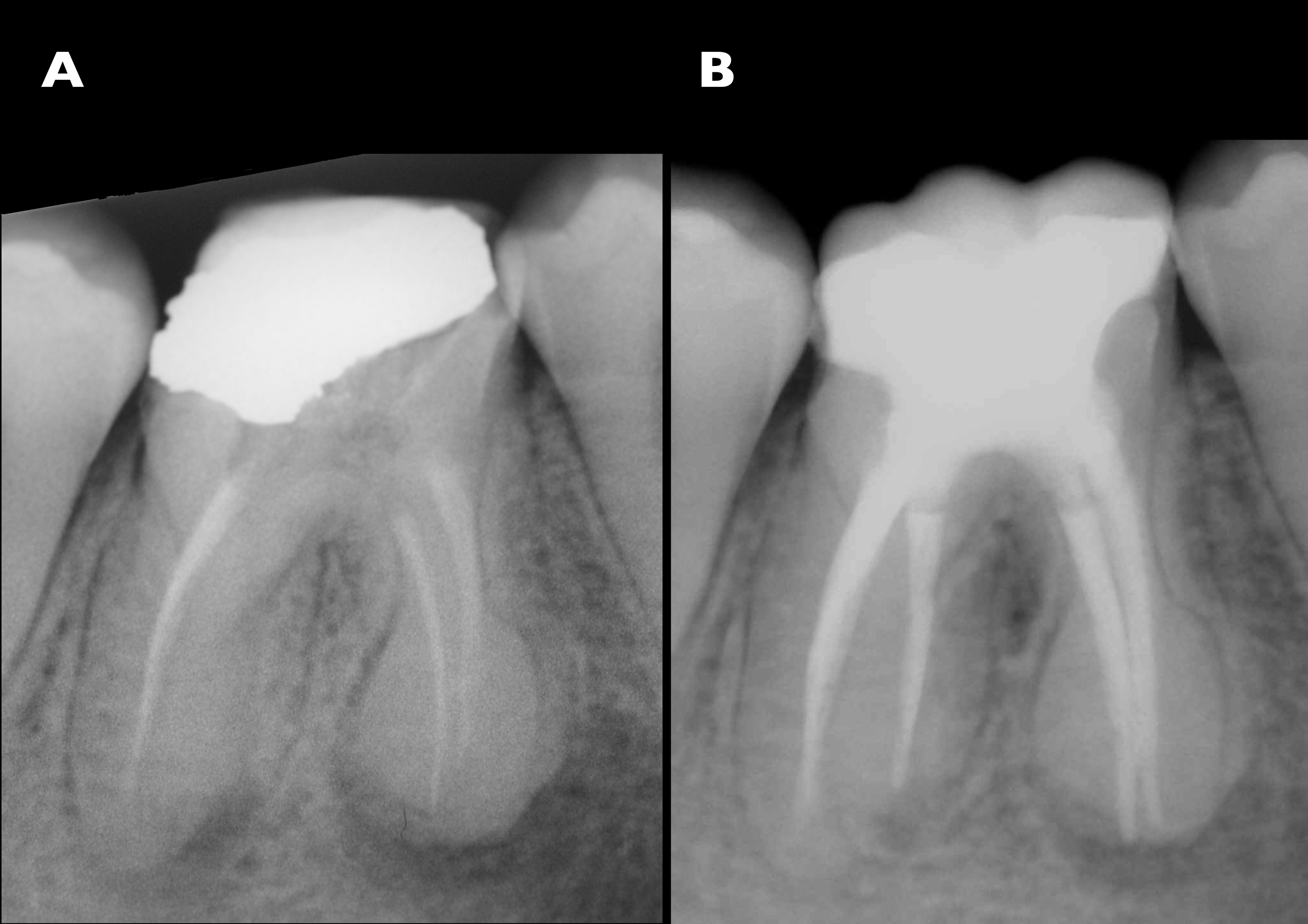 Figs. 23a & b: Radiographs before (a) and after (b) treatment, showing dramatic differences. The endodontic treatment had been corrected and the restoration was well adapted and shaped. The interproximal relationships had been re-established through the anatomy of the endocrown. There were no gaps between the restoration and the endodontic filling. The sealing of the endodontic treatment was complete and tight.