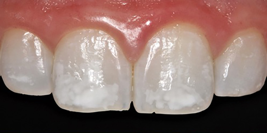 Fig. 2a: Maxillary incisors prior to resin inltration treatment. Note the increased contrast between the white spot lesions and sound enamel after vital tooth bleaching. Anterior view.