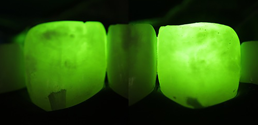 Fig. 3a: Transillumination of the maxillary right and left central incisors using different light lters to visualise lesion depth and extent (after dental dam application and tight oss ligation). The darker areas suggest deeper lesions. Transillumination with a green lter.