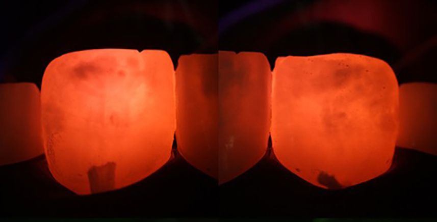 Fig. 3b: Transillumination with an orange lter. Note the consistent presentation between the different light lters. Transillumination suggested a slightly deeper lesion on the left central incisor.