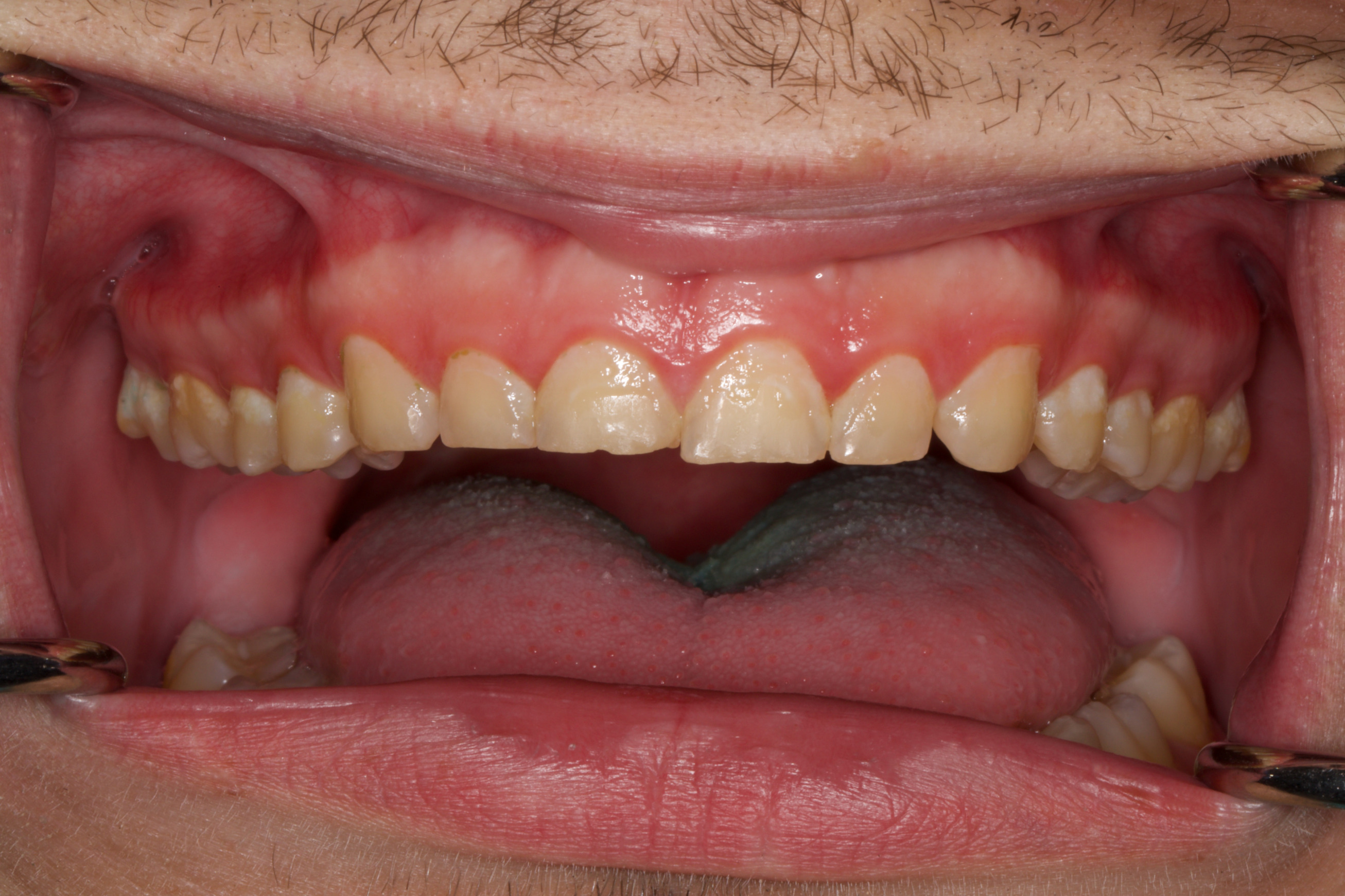 Fig. 2: Intra-oral photograph showcasing the extensive wear.