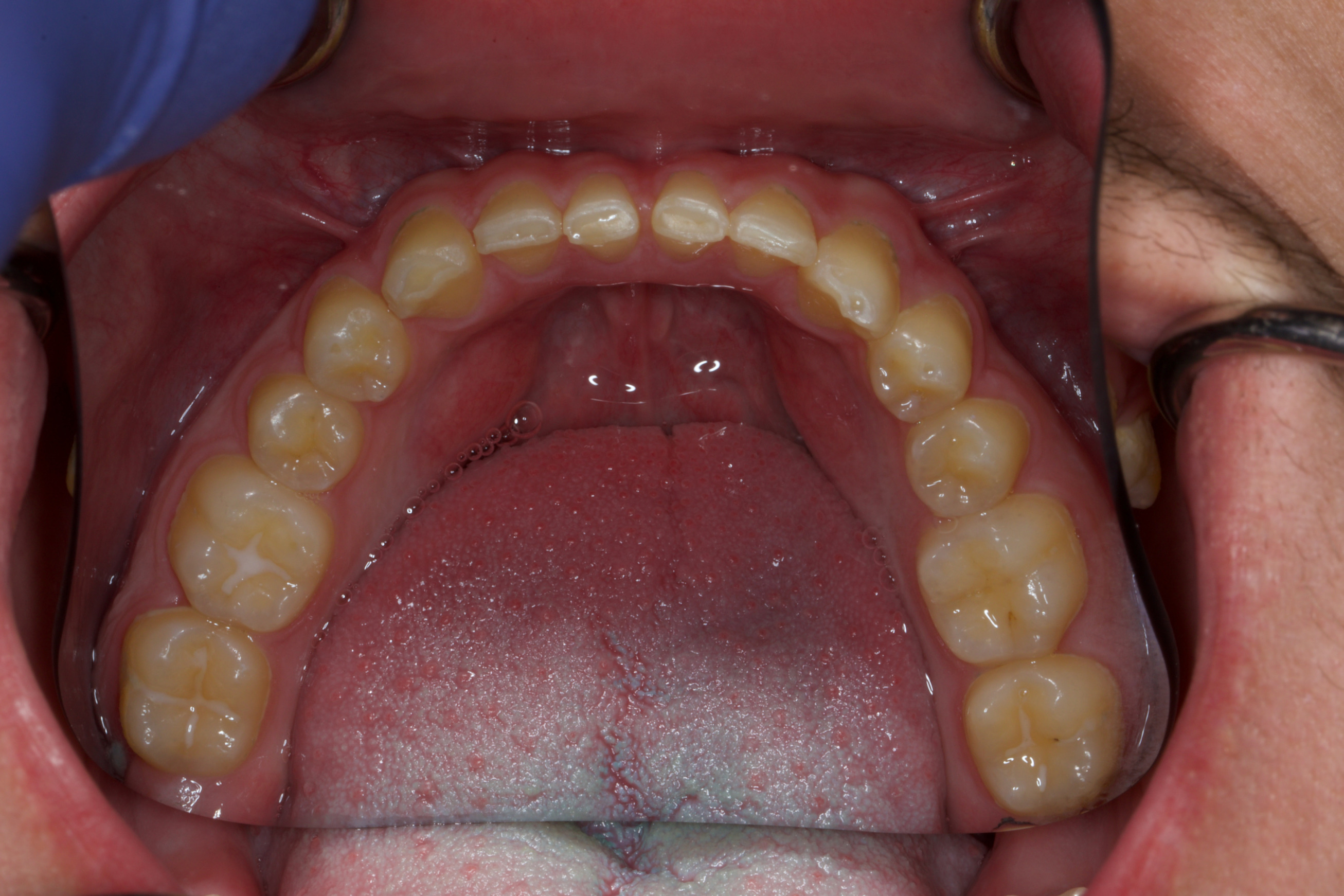 Fig. 4: Intra-oral photograph of the mandibular arch.