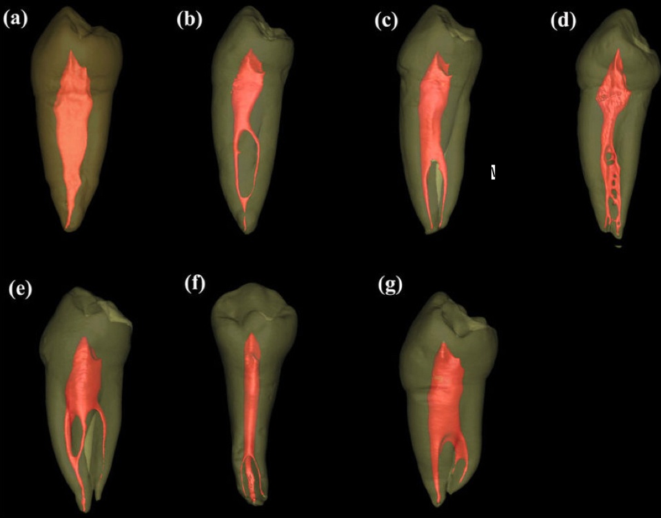 Fig 1. Vertucci Calssification-Premolars