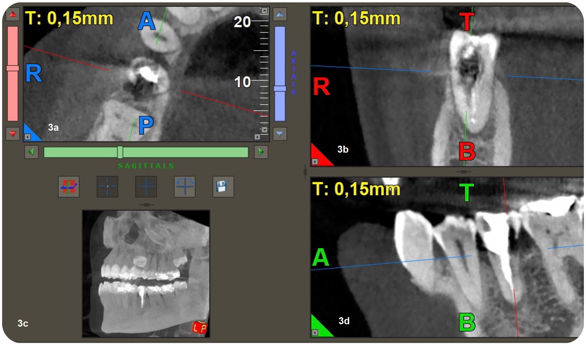 Figs. 3a–d: 3D reconstruction of axial section showing extension in mesial-distal direction (a). 3D reconstruction of a sagittal section showing the lesion extension, buccal-palatal direction (b). Coronal section of CBCT showing the extension of the periapical lesion and the resorptive defect (c). CBCT scan (d).