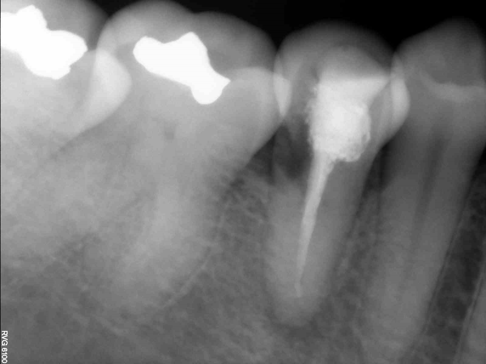 Fig. 2: Periapical radiograph of the initial situation.