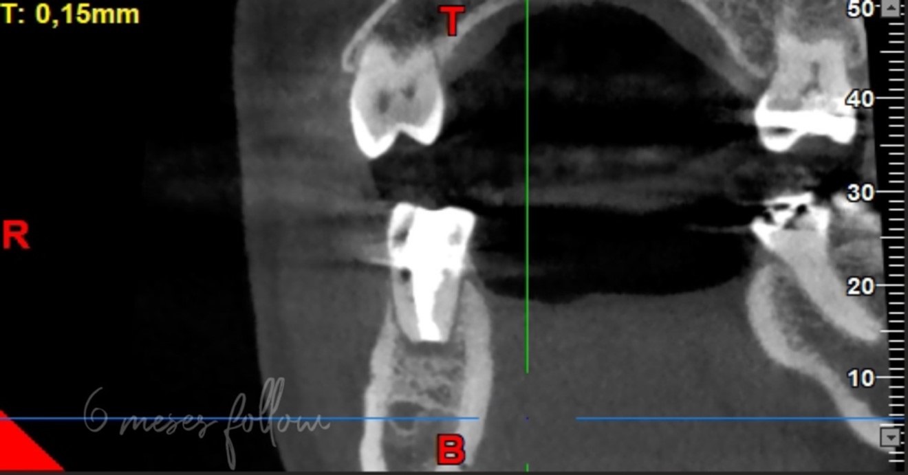 Fig. 6: Sagittal section of the CBCT scan six months after treatment showing almost complete healing of the periapical lesion.