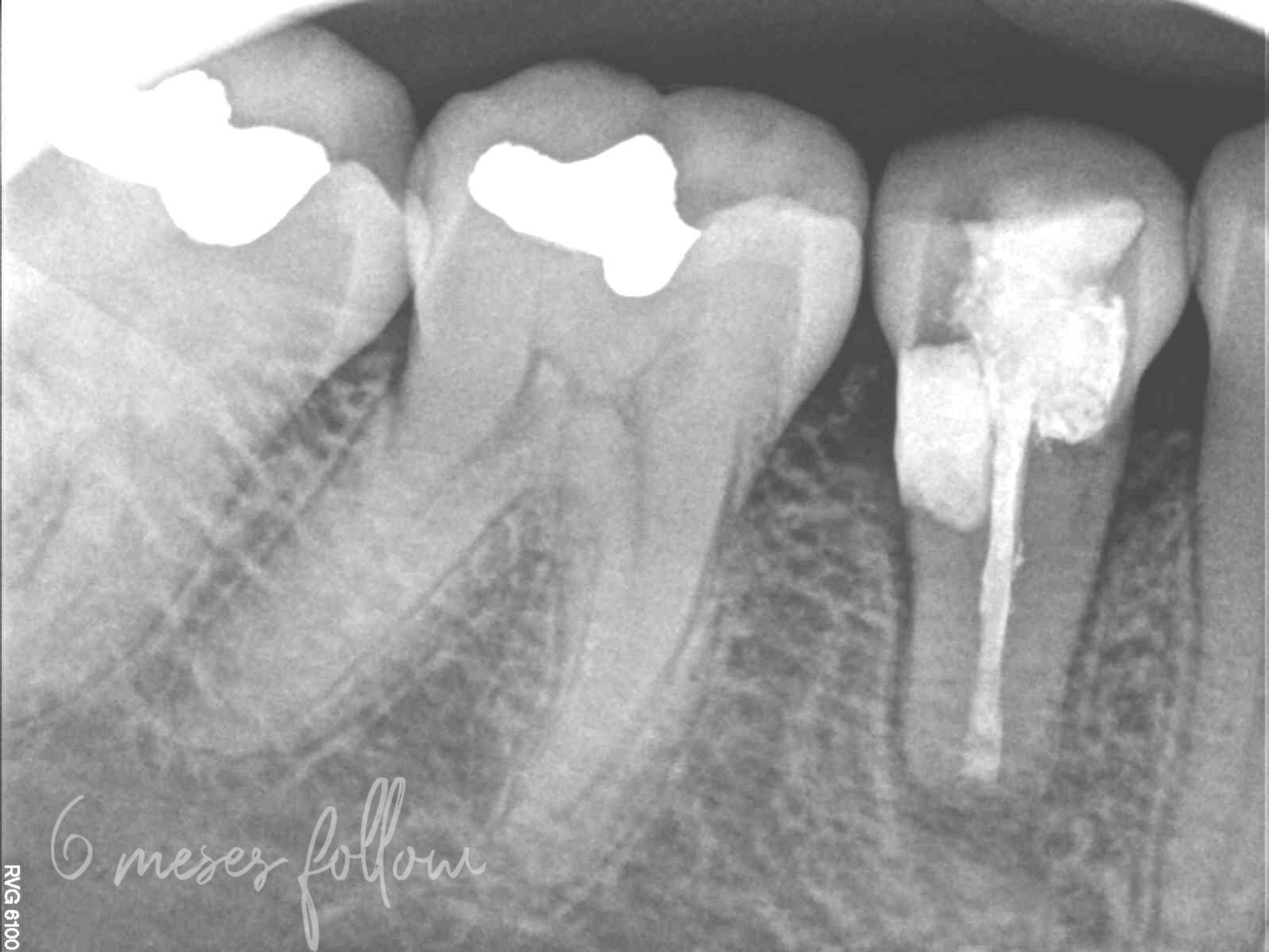 Fig. 7: The periapical radiograph at six months showed almost complete healing and no signs of apical pathosis.