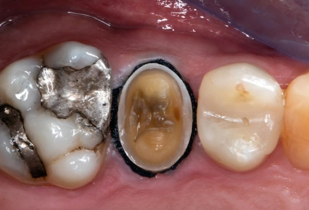 Fig. 2: An example of a clean and dry crown preparation with the gingiva retracted sufficiently ready for scanning.