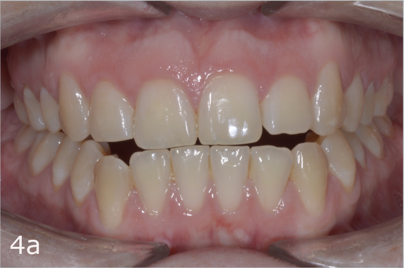 Class III malocclusion treated with clear aligners