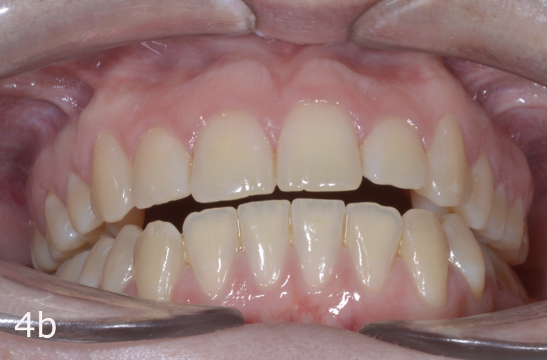 Class III malocclusion treated with clear aligners