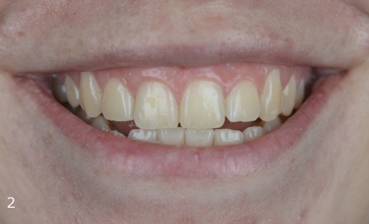 Class III malocclusion treated with clear aligners