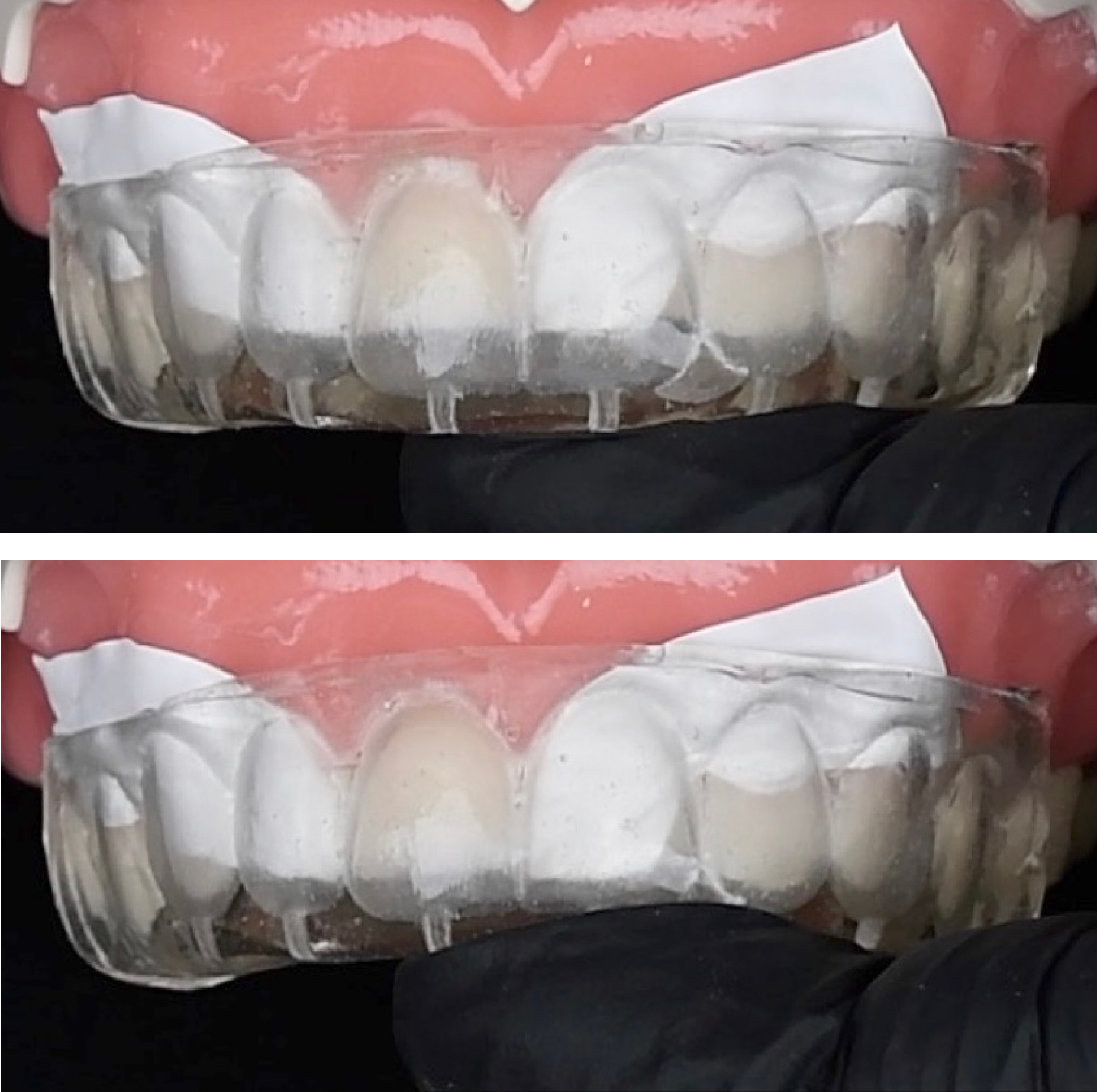Flowable injection technique how to avoid air bubbles