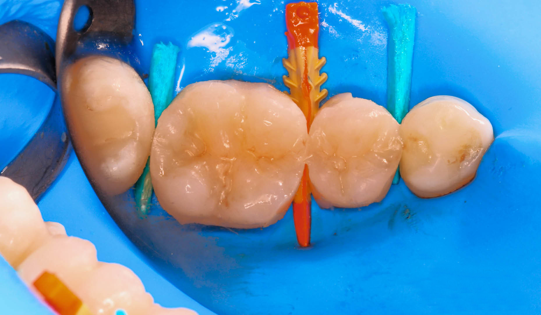 How to polish a composite restoration in posterior area